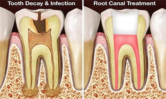 عمر دندان عصب کشی شده چه قدراست؟
