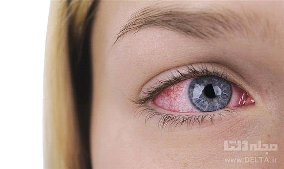 قرمزی چشم یکی از علائم مبتلایان به کرونا است؟