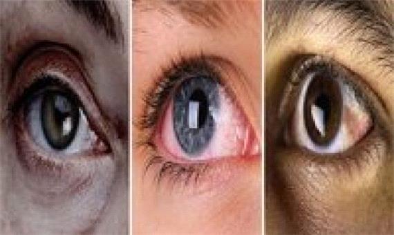 چشم‌های خشک؛ عارضه استفاده طولانی‌مدت از گوشی‌های هوشمند