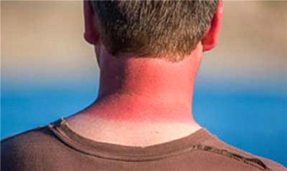 آفتاب‌سوختگی بیش از حد چه بلایی سرتان می‌آورد؟