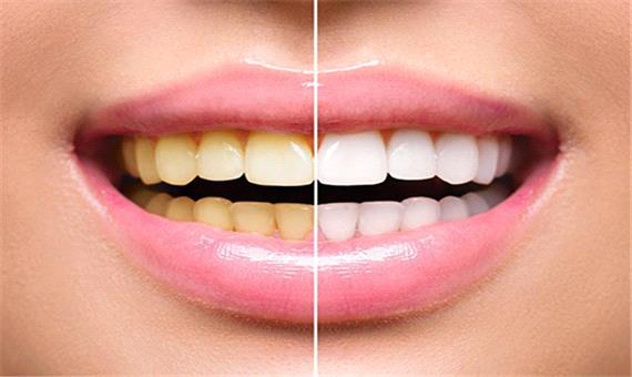 10 روش طلایی برای سفید کردن دندان‌ها