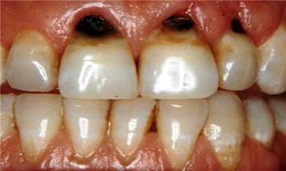 جلوگیری از پوسیدگی دندان‌ها به کمک نانوذرات