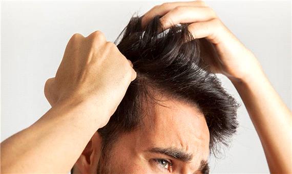 مشکل مردانه‌ی ریزش مو چیست!؟