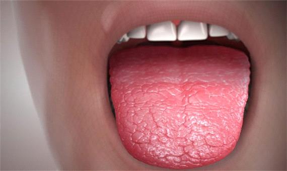 آنچه از خشکی دهان باید بدانید