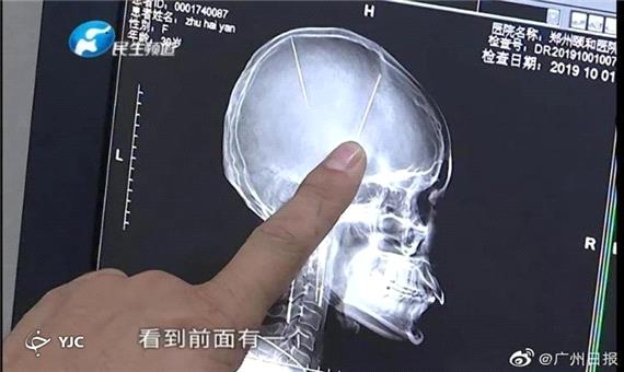 4گوشه دنیا/ شوک زن چینی پس از دیدن عکس اسکن مغز خود!