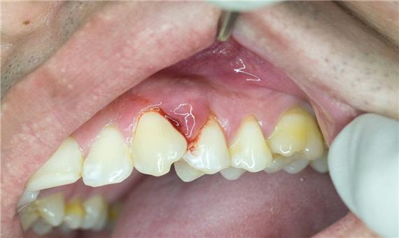 مخرب‌ترین تاثیرات دیابت نوع 2 بر دهان و دندان