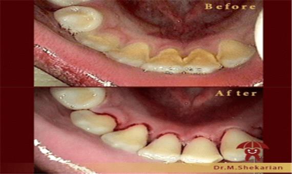 آیا جرم گیری دندان کودکان عوارض دارد ؟