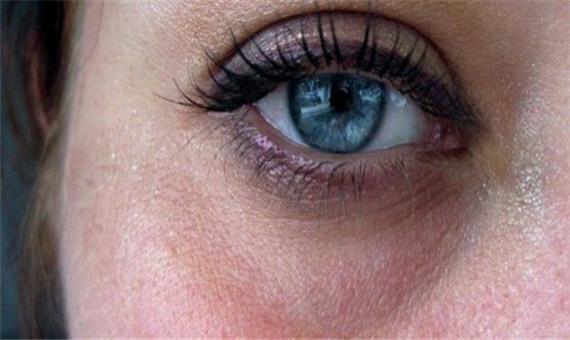 5 روش درمان خشکی چشم