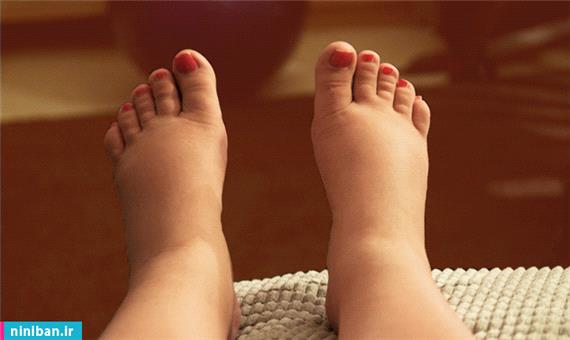 درمان آسان تورم پا در مادران باردار