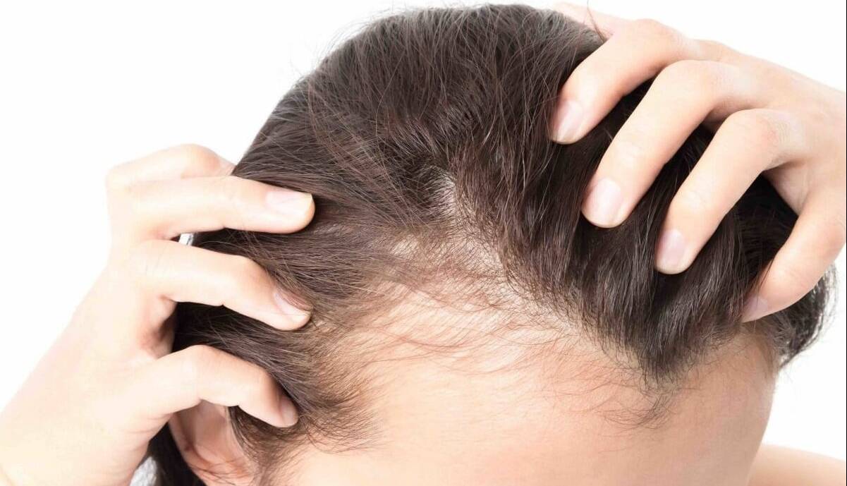 چهار توصیه مهم برای کسانی که ریزش مو دارند