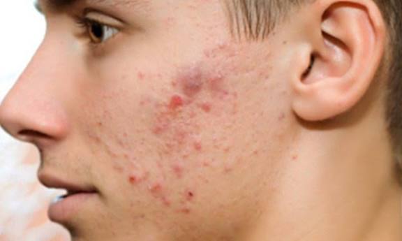 ۴ راهکار برای مقابله با آکنه در سرما