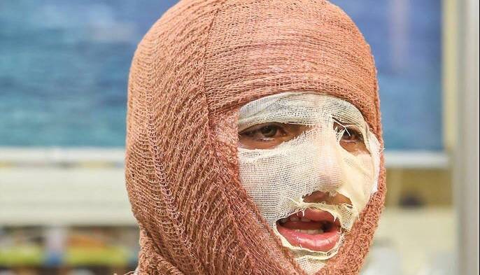 سوختگی؛ آسیب جسمی و روانی که فراتر از درمان است