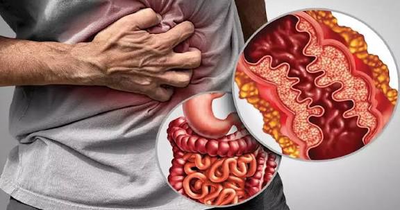 بیماری کرون چیست و چه عوارضی دارد؟