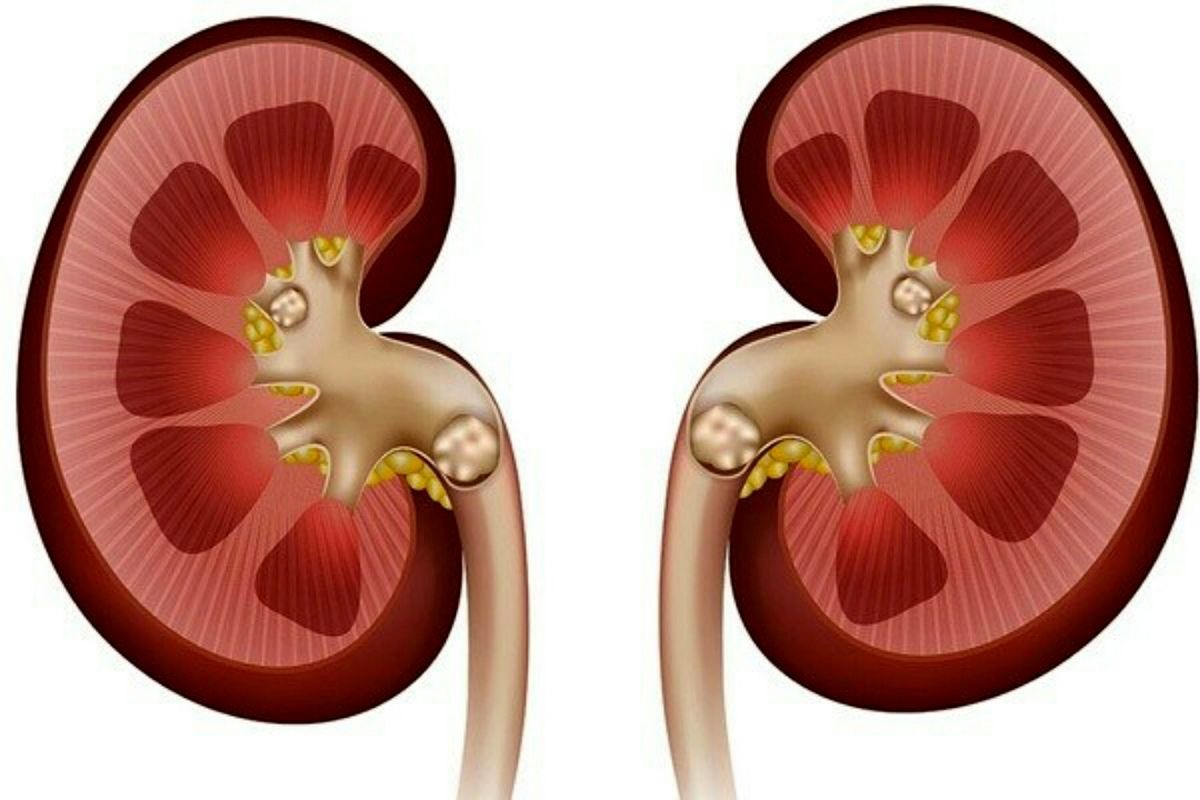 انواع روش های درمان سنگ کلیه