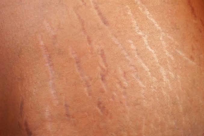 شایع‌ترین عوامل ترک‌‌های پوستی