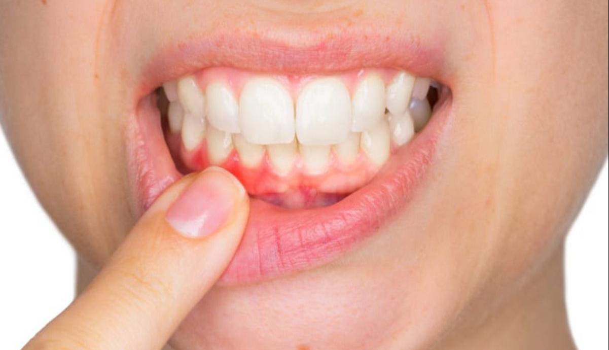 ورم لثه؛ نشانه‌ها و مراقبت‌ها