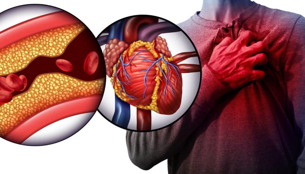 آیا کلسترول متهم اصلی گرفتگی عروق است