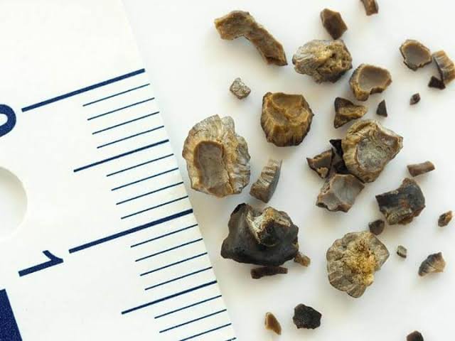 سنگ مثانه از سنگ کلیه خطرناک تر است؟