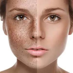 هر کدام از هضم‌های بدن مختل شود، لک پوستی ایجاد می شود!