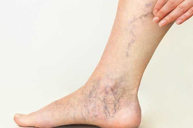 آیا غلظت خون باعث واریس می‌شود؟