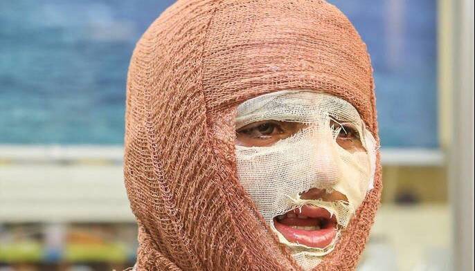 آیا بهبود کامل پس از سوختگی‌های عمیق امکان‌پذیر است؟