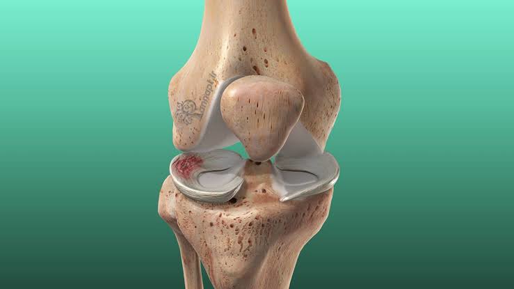 علت های اصلی پارگی مینیسک زانو!