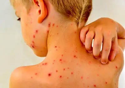 آنچه والدین باید درباره آبله مرغان و زونا بدانند