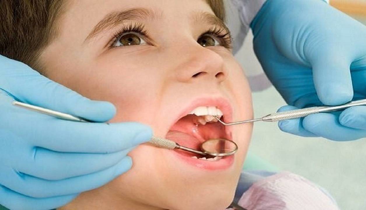 کاهش ۴۰ درصدی پوسیدگی دندان با انجام صحیح دو بار وارنیش فلوراید