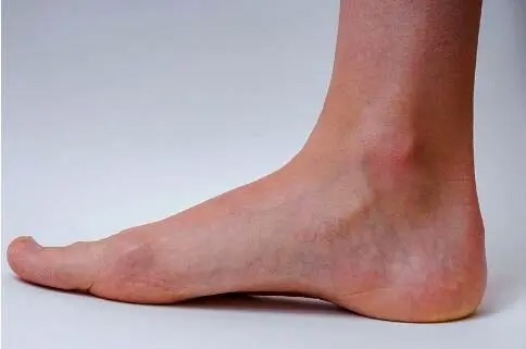 برای پیشگیری از «واریس» چه کنیم؟