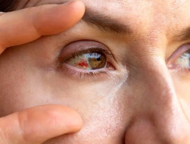 دلایل پارگی رگ خونی در چشم؛ چه موقع باید به پزشک مراجعه کنیم؟