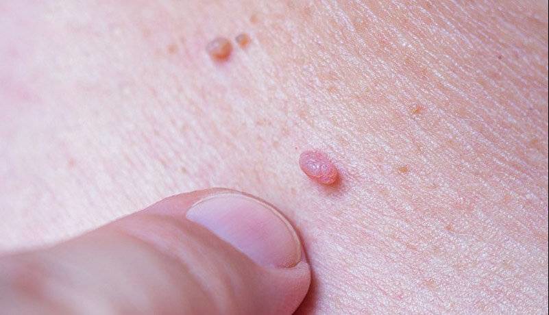 ویروس زگیل از باشگاه ورزشی منتقل می‌شود؟