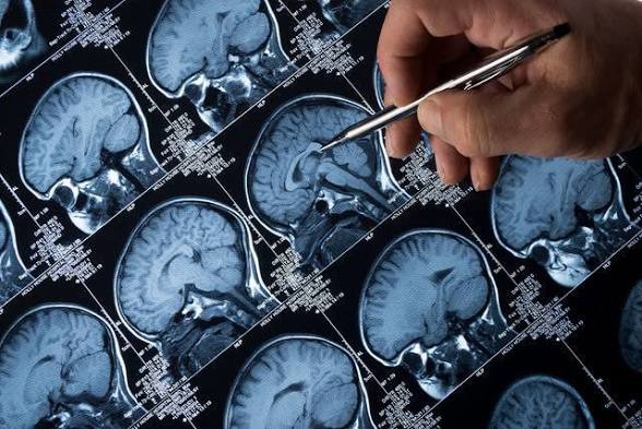 تمام عوامل مؤثر در ابتلا به آلزایمر!